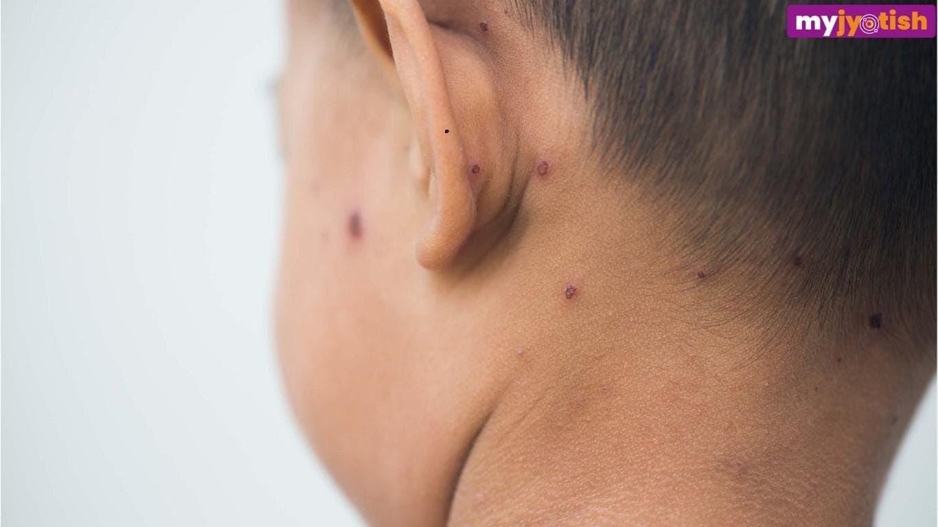 Moles on Face: चेहरे के इन अंगों पर तिल होने से व्यक्ति होता है लकी, खूब कमाते हैं धन